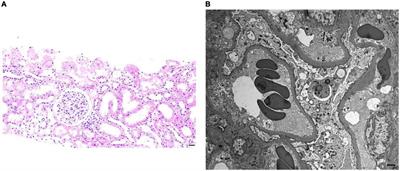 Case report: Successful outcome of treatment using rituximab in an adult patient with refractory minimal change disease and β-thalassemia complicating autoimmune hemolytic anemia